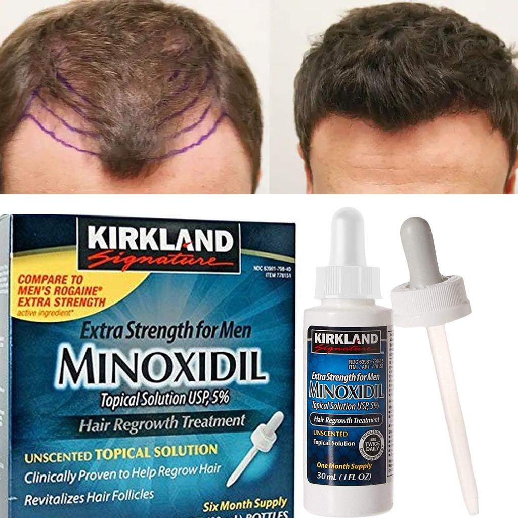 What compares to Minoxidil - scam or legit - side effect